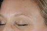 Botox