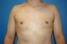 Gynecomastia procedure