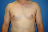 Gynecomastia procedure