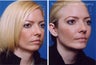 Submental Liposuction (chin/neck) with Chin Implant
