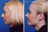 Submental Liposuction (chin/neck) with Chin Implant