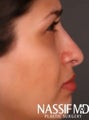 Hispanic Female Rhinoplasty
