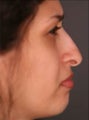 Hispanic Female Rhinoplasty