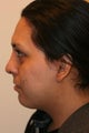 Submental liposuction and revision rhinoplasty