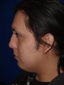Submental liposuction and revision rhinoplasty