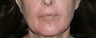 Before and After Fraxel Laser