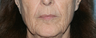 Before and After Fraxel Laser