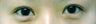 Bilateral Asian Eyelid Surgery w/ Medial Epicanthoplasty