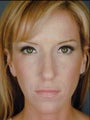Female Primary Rhinoplasty