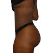 6 Month Post Operative Liposuction
