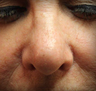 Sunspot Treatment