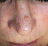 Sunspot Treatment
