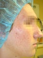 Acleara with microextraction head