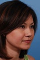 Asian Rhinoplasty
