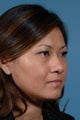 Asian Rhinoplasty