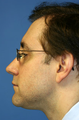 Chin/Neck Liposuction
