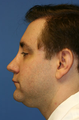 Chin/Neck Liposuction