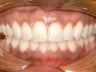 Spaces between the front teeth