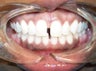 Spaces between the front teeth