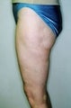 Female patient who underwent liposuction