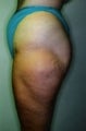 Female patient who underwent liposuction