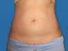 Abdomen CoolSculpting