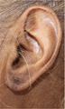 Torn Earlobe Repair