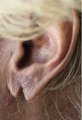 Torn Earlobe Repair