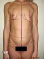 Body Lift & Breast Augmentation