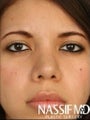 Hispanic Female Rhinoplasty