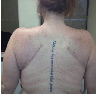 Back Lift/ Bra Roll Lift