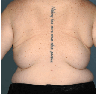 Back Lift/ Bra Roll Lift