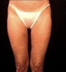 Thighplasty/Body Lift