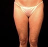 Thighplasty/Body Lift