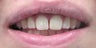 Filling to Repair Broken Tooth