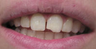 Filling to Repair Broken Tooth