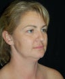 Cheek Fat Pad Removal