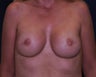 immediate bilateral mastectomy and immediate reconstruction