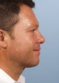Male Treated for Heavy Neck