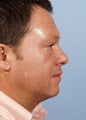 Male Treated for Heavy Neck