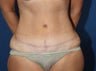Abdominoplasty (Tummy Tuck) with Abdomen and Flank Liposuction and Inverted T Mastopexy (Breast Lift)
