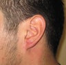 gauge earlobe repair, earlobe reconstruction