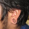 gauge earlobe repair, earlobe reconstruction