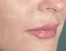 Lip Filler