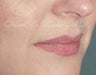 Lip Filler