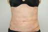 60 Year Old Female treated for fat removal - Smartlipo