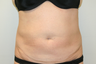60 Year Old Female treated for fat removal - Smartlipo