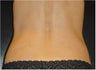 SmartLipo MPX