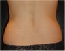 SmartLipo MPX