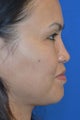 Nonsurgical Rhinoplasty for Bridge and Tip Augmentation/Refinement